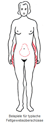 Operationsverfahren bei der Fettabsaugung (Liposuktion)